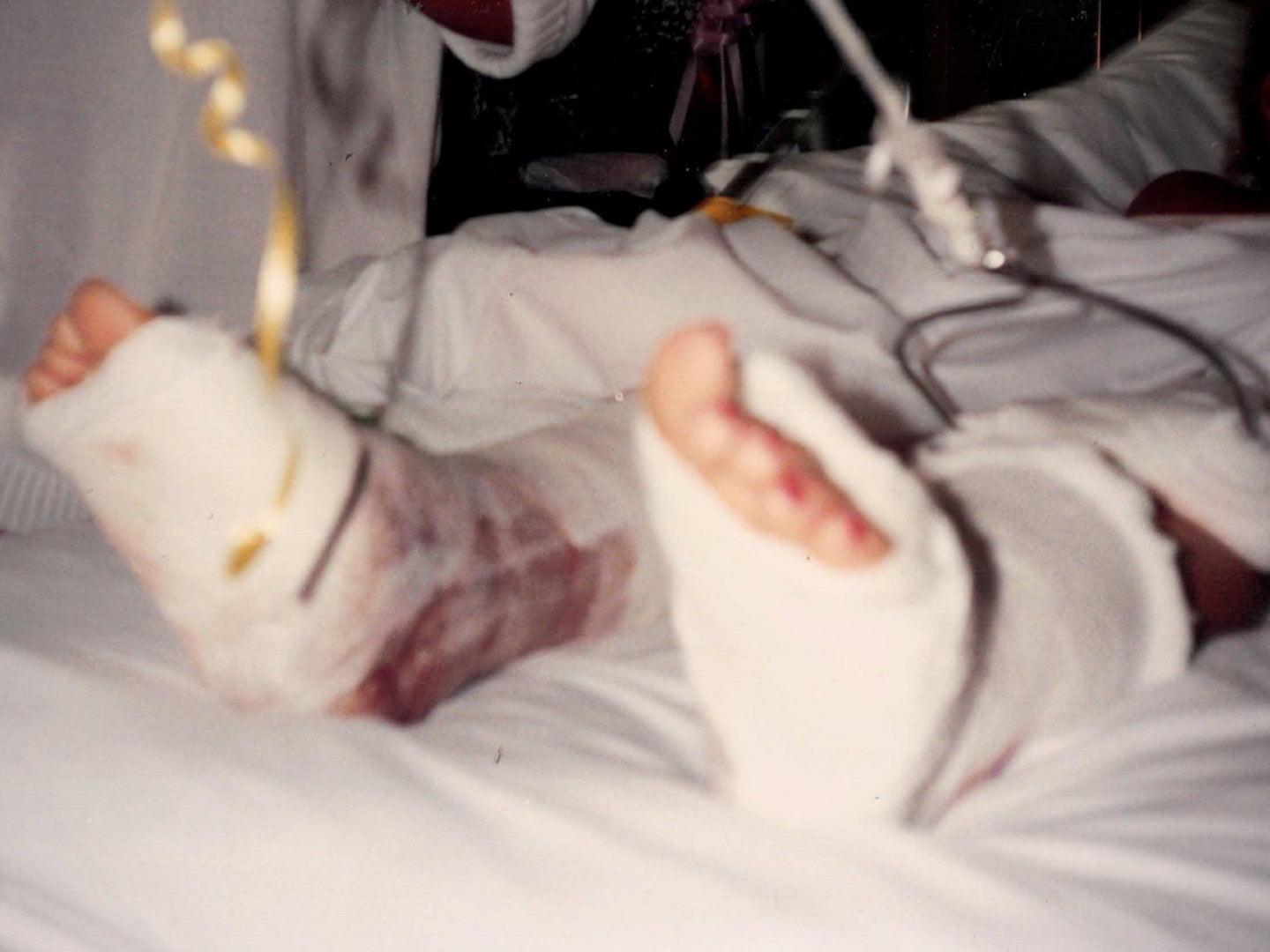The image shows a young Debra Myers lying in a hospital bed with both legs in casts, likely due to serious injury. The bandages and visible swelling/bruising suggest recent trauma, possibly from an accident. Medical tubes and hospital bedding are visible, indicating that Debra is receiving treatment.