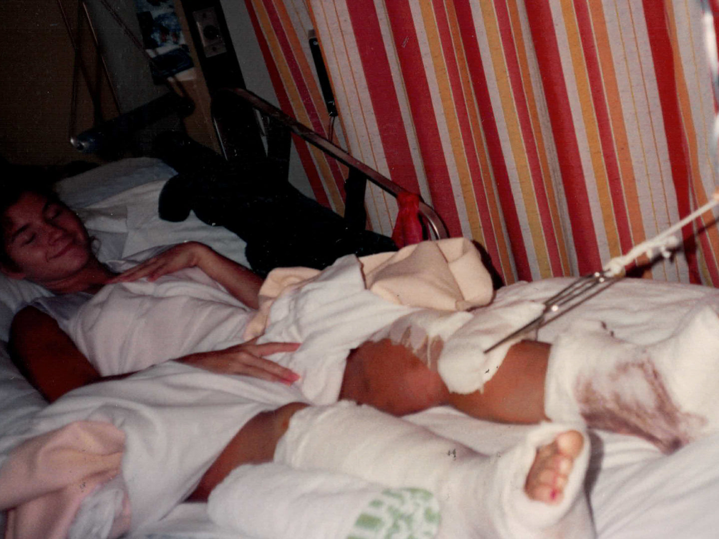 The image shows a young Debra Myers lying in a hospital bed with casts on both legs, one of which appears to have surgical hardware attached for stabilization. There are visible signs of bruising and injury, likely from a serious accident. The patient has a calm or faintly smiling expression despite the injuries, and the background includes striped hospital curtains.